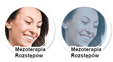 Mezoterapia rozstępów