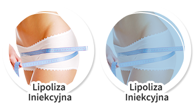 Lipoza iniekcyjna